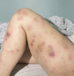 Бледность кожных покровов один из симптомов лимфолейкоза